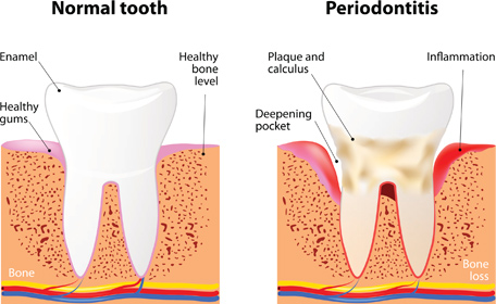 Mill Valley Periodontal Disease